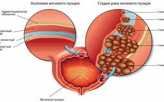Опухоль мочевого пузыря у мужчин и женщин: симптомы, лечение и причины