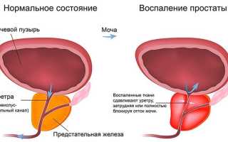 Урология болезни народными средствами