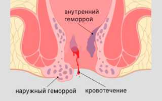После туалета печет прямая кишка. Как лечить жжение и зуд в заднем проходе после поноса