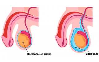 Болезнь водянка и ее симптомы. Лечение заболевания