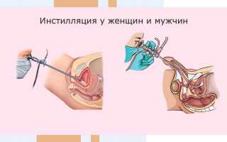 Что такое инстилляция мочевого пузыря и как она проходит у женщин и мужчин?