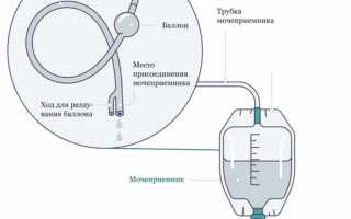 Как можно промыть катетер урологический