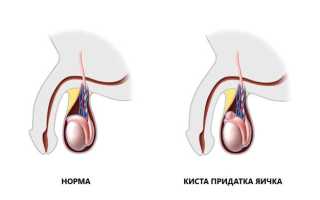 Урология киста в придатке