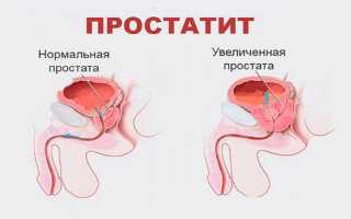 Урологический пластырь для мужчин: инструкция по применению