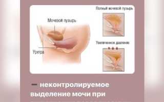 Способы лечения недержание мочи при кашле у женщин