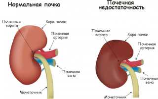 Лечение почечной недостаточности хронической формы, диализ