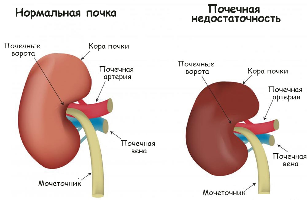 Лечение хронической почечной недостаточности и прогноз